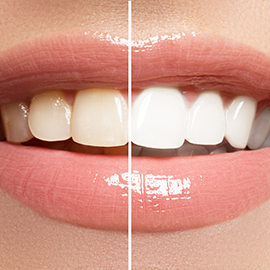 Bleaching Pic