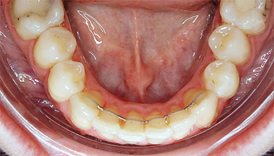 Retainer